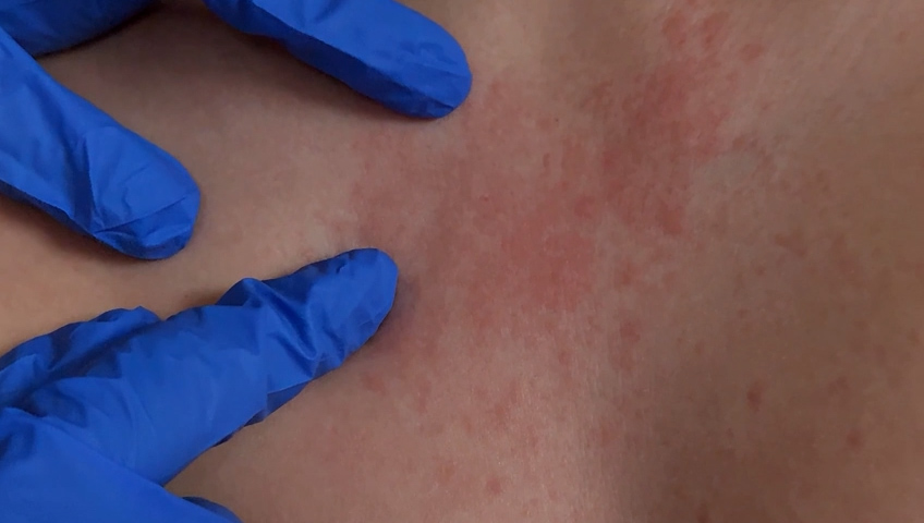 Alerta en Mexicali por Brote de Sarampión: Detectan Paciente Cero