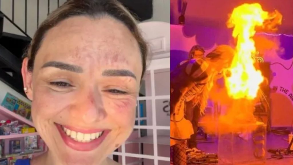 Arlen Hernández sufre quemadura facial por ‘pastel explosivo’: lo que necesitas saber