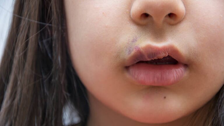 Hendiduras Orofaciales: Una de las Malformaciones Congénitas Más Frecuentes en México