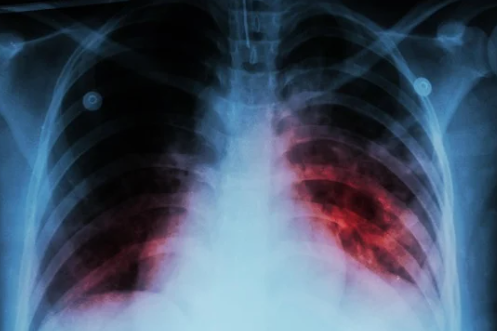 Aumento Preocupante de Casos de Tuberculosis en Nevada Durante el Día Mundial de la TB