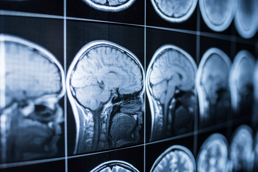 Lesiones Cerebrales en Colorado: Medio Millón de Residentes Afectados y Nueva Herramienta de Evaluación
