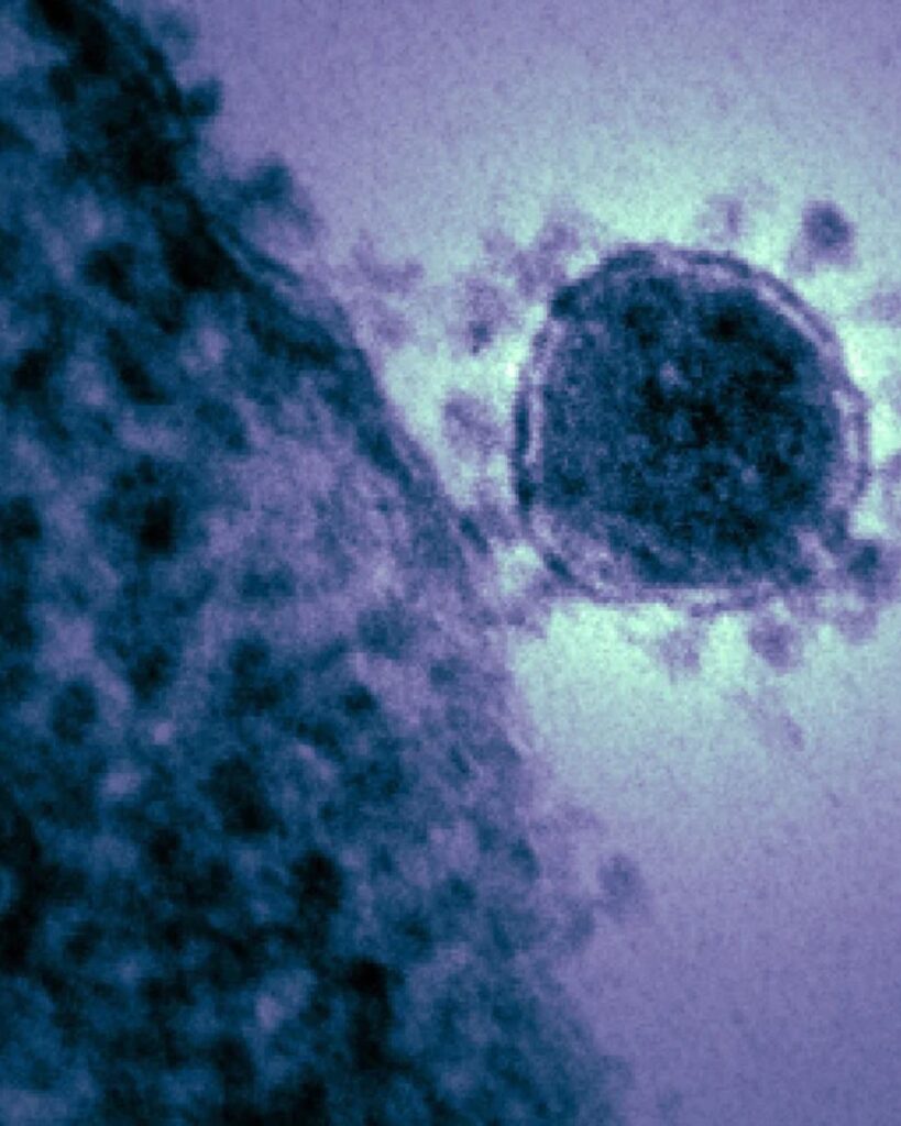 Mpox: detectan 1 primer caso del clado I de viruela símica en el Condado Clark